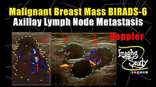 Malignant Breast Mass with Axillary Nodal Metastasis - BIRADS 6 || Ultrasound || Doppler || Case 262