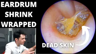 Shrink Wrapped Ear Drum Cleaned Of Dead Skin