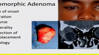 AIOC2018 - GP040 - Topic - Orbital Tumors: Approach to Pandora’s Box