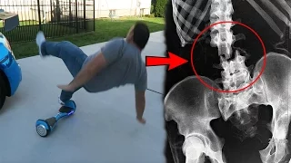 MY DAD BROKE HIS BACK RIDING A HOVERBOARD! - FAIL