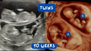 Cute Ultrasound Video of Twins at 11 Weeks Gestation  | Scan of the Week