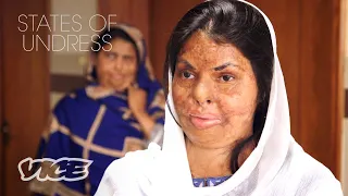 I Survived an Acid Attack | STATES OF UNDRESS