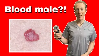 Haemangioma, Adult Onset: Doctor Explains Why That's Not A Mole!