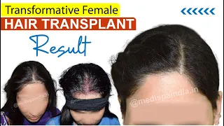 Female Hair Transplant Results in India | Medispa Hair Transplant India