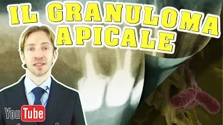 Il Granuloma Apicale