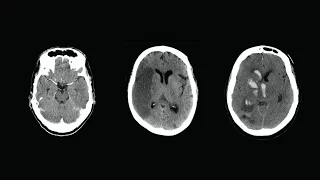 How to Read a CT Scan of the Head - MEDZCOOL