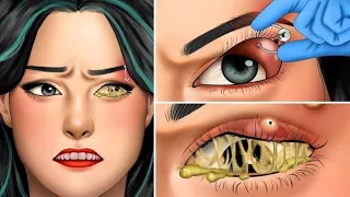 ASMR Remove unmanaged eyebrow piercing pus animation | Squeeze eyes acne@Medicalpart