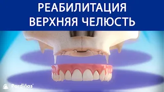 Реабилитация верхняя челюсть с 6 зубные имплантаты ©