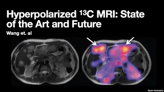 Hyperpolarized 13C MRI - Saurin Kantesaria