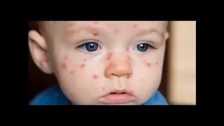Varicella Zoster Virus ( Chicken pox and Shingles)