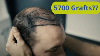 Dennis' Haartransformation: 5700 Grafts bei Biohair