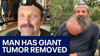 Scottsdale man has giant tumor removed from face