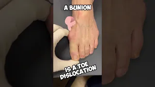 What is a Bunion?