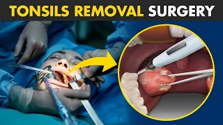 How Tonsillectomy Procedure Is Performed? | Tonsils Removal Surgery (Tonsillectomy)