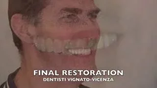 Riabilitazione arcata dentale superiore