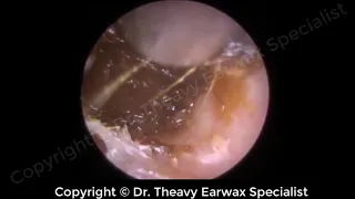 Daily Earwax Removal Extraction #37 by Dr Theavy Earwax Specialist