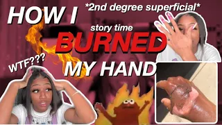 STORYTIME: HOW I BURNED MY HAND [PICTURES + VIDEOS INCLUDED]