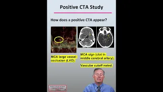 CT Angiography (CTA) Positive Imaging and Patient Treatment in Acute Ischemic Stroke Patients 1017