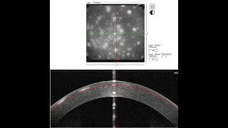 High Resolution en Face OCT of Adenovirus Keratitis .