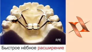 Аппараты  Хайрекс (HYREX), Дерихсвайлера, Haas.Ортодонтия.