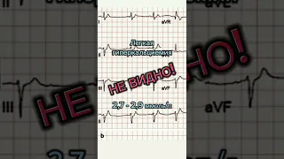 #гиперкальциемия  #ecg #экг #ekg