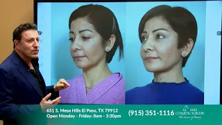 GLIDELIFT - LATEST FACELIFT TECHNIQUE WITH NO VISIBLE SCARS BY DR OZAN SOZER