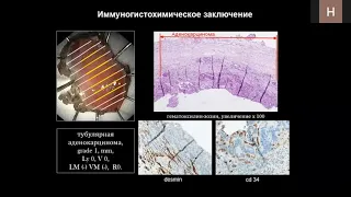 1 Соколов, Ленский Этапное лечение пациента с раком пищевода, пищеводом Барретта и хиатальной грыжей