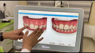 طريقة تركيب تقويم الأسنان انفيزالين التقويم الشفاف الانفيزالين بالخطوات