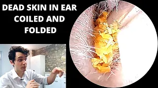 Tightly coiled dead skin blocking the ear extracted (pre keratosis obturans discussed)