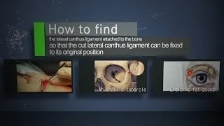 lateral canthus reconstruction how to find the lateral canthus ligament