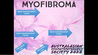 Myofibroma 101 explained in 5 minutes (pathology dermpath dermatology)