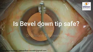 Bevel down phaco- is it safe? Dr Sourabh Patwardhan