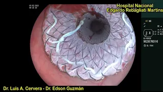 Removal of migrated esophageal SEMS and repositioning in a patient with GEJ neoplasm