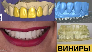 3D печать зубов моделировка виниров Стас Белоус