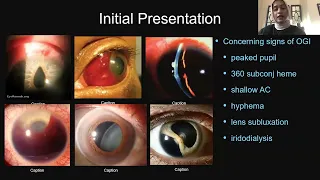 Lecture: Pediatric Ocular Emergencies and Trauma