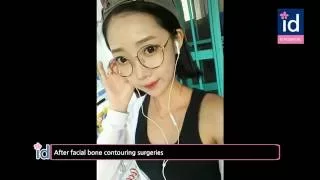 Korean Jawline and Cheekbone Reduction Surgery (Korea Plastic Surgery Before and After)
