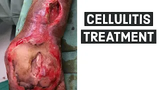 CELLULITIS