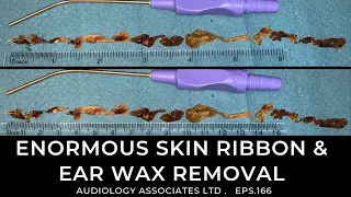 ENORMOUS SKIN RIBBON AND EAR WAX REMOVAL - EP166