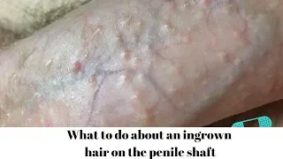 What to do about an ingrown hair on the penile shaft