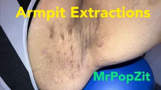 Armpit (axillae) extractions. Blackheads, whiteheads. Oxidized Keratin Plugs in pores removed.