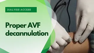 AVF Decannulation procedure + avf cannulation techniques