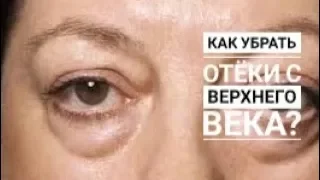 Как снять отек с верхнего века?