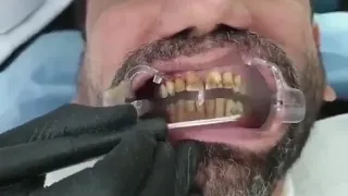 Teeth stain removal with Airflow