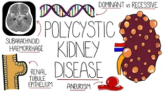 Polycystic Kidney Disease Explained