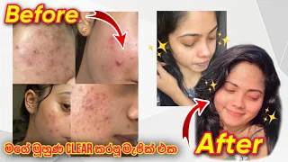 මාසෙකින් pimples නැති කරපු මැජික් එක 🧏🏻‍♀️✨ #vlog #skincare #clearskin