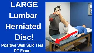 Positive Well Straight Leg Raise Test (Large Herniated Disc)