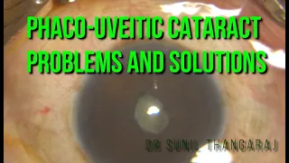 Phaco in a Complicated Cataract - Post Uveitis