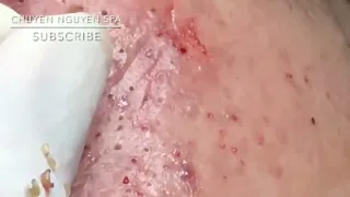 Satisfying and relaxing blackheads, pimple pop - Nhat Bang Acne Treatment- Chuyen Nguyen Spa #9