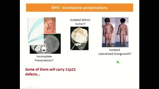 E05 2 F  Brioude: Clinical and molecular overview of Beckwith Wiedemann %26 Silver Russel syndromes