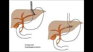 EUS  guided hepaticogastrostomy or eus guided billiary drainage
